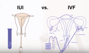 IVF vs IUI